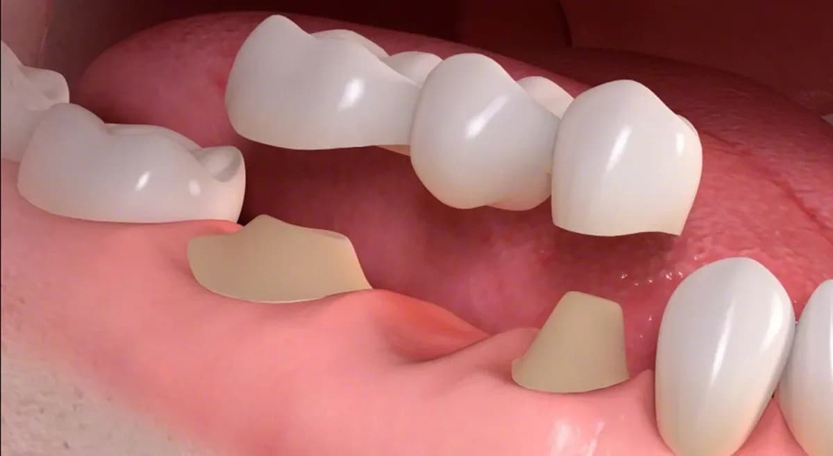 Dental bridges in St. Albert