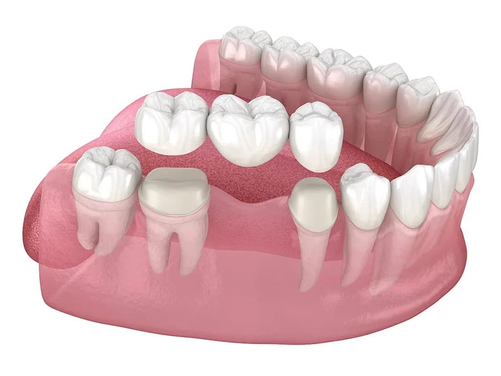 Porcelain crowns in St. Albert