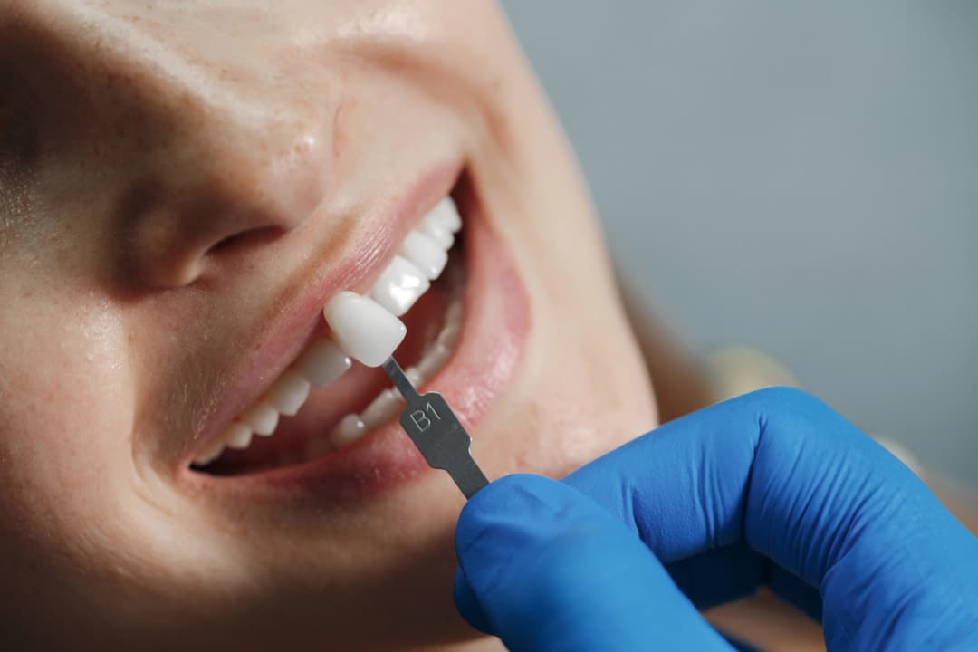 Porcelain veneers in St. Albert