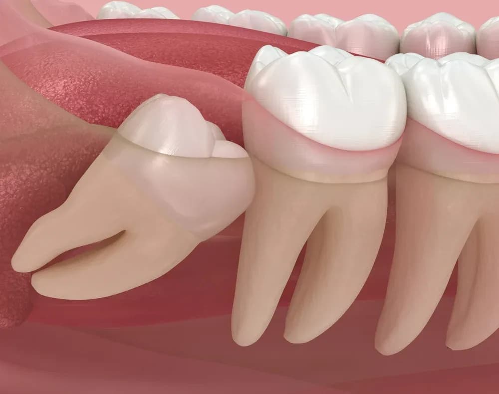 Tooth and wisdom tooth extractions in St. Albert
