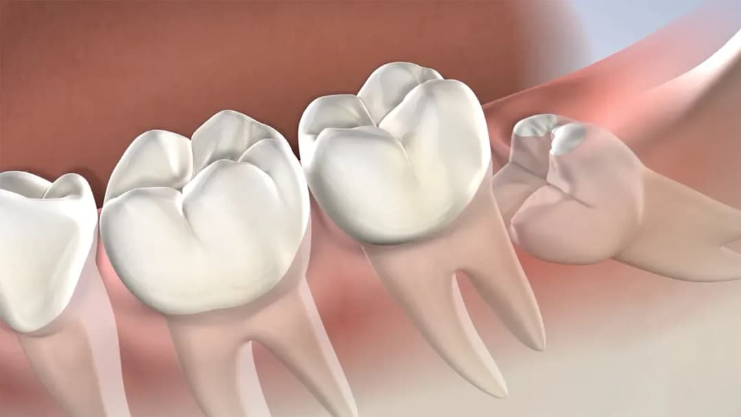 Comfortable tooth extraction care